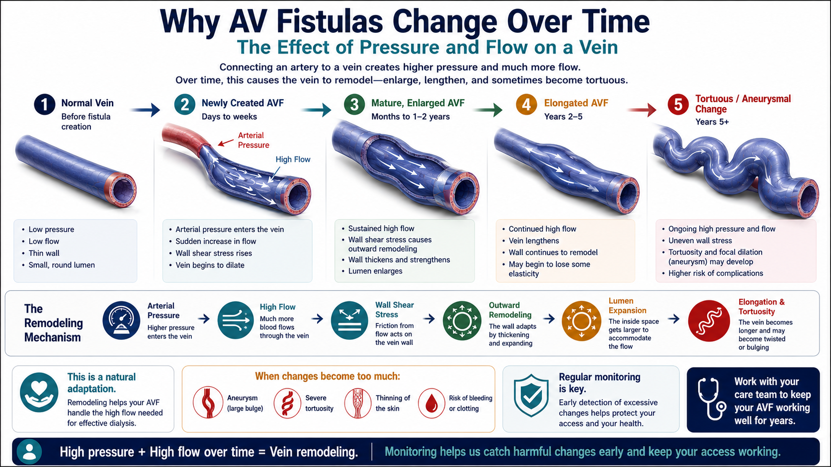 Flow and pressure biology of AVF remodeling — normal vein, AVF, and mature enlarged AVF progression, diagram — by W Rivero, MD