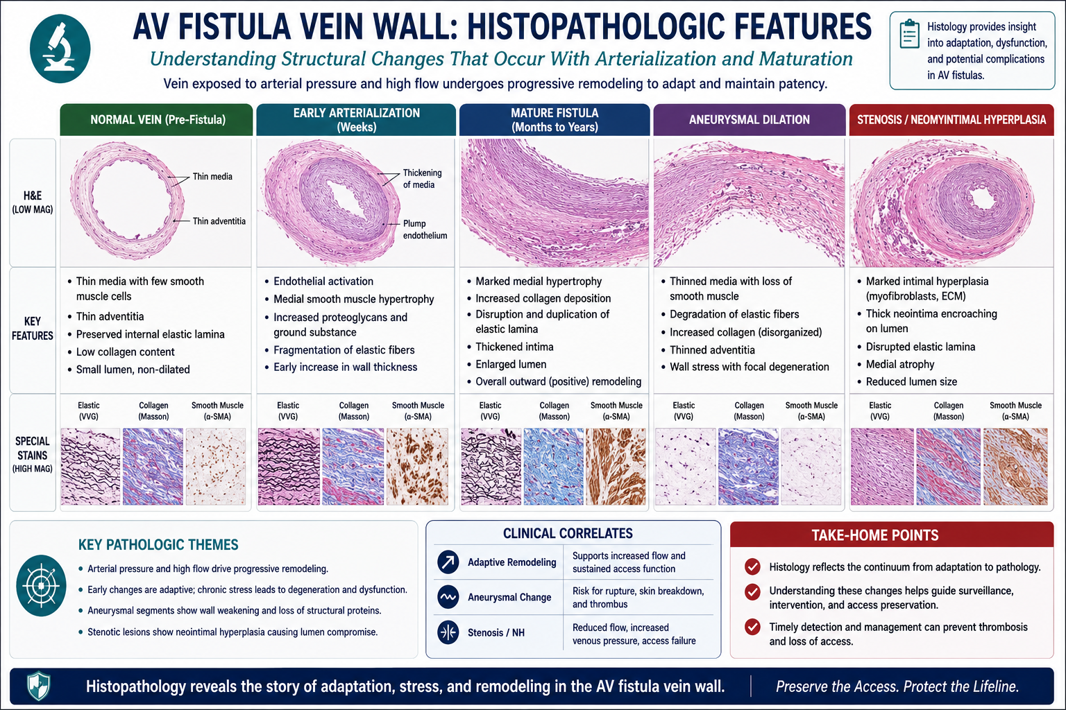 AVF wall histopathology at three timepoints — normal vein, early AVF with intimal hyperplasia, late AVF with pseudoaneurysm/fibrotic/calcified zones; clinician reference — by W Rivero, MD