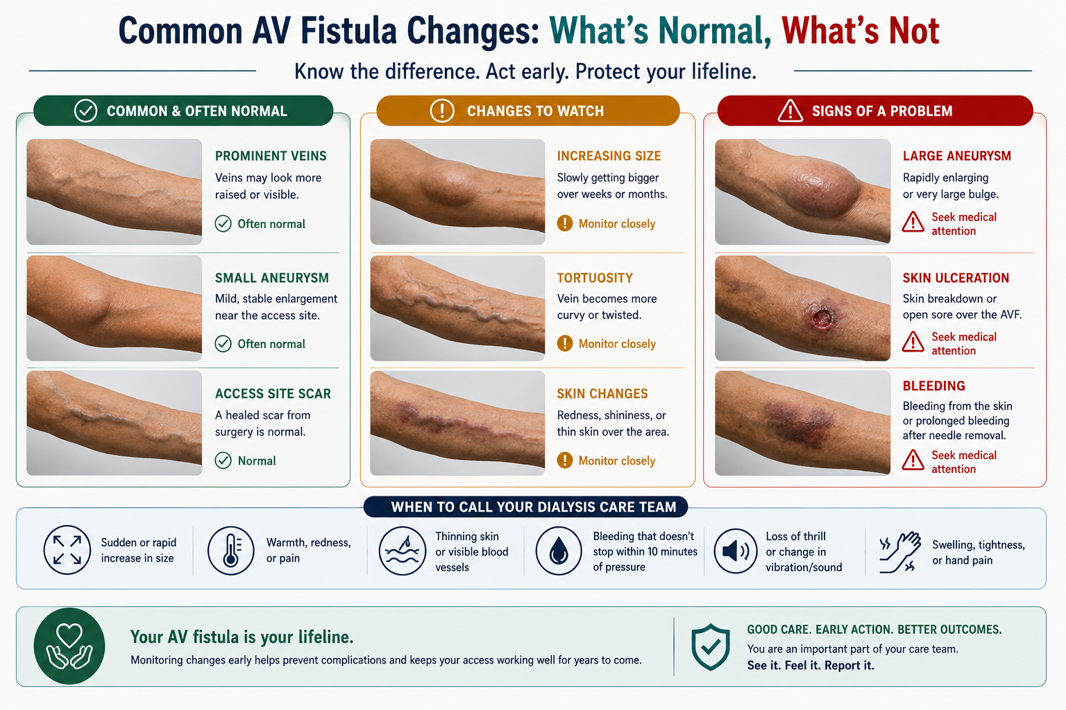 Eight warning signs for dialysis access requiring immediate emergency care — patient education poster — by W Rivero, MD
