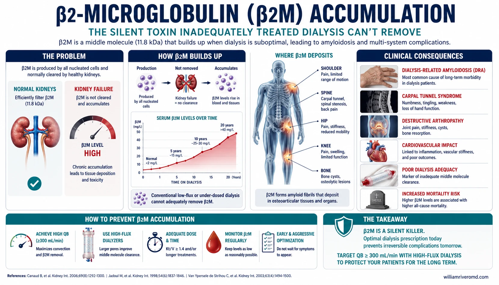 Beta-2 microglobulin accumulation timeline — from silent buildup to dialysis-related amyloidosis over years of inadequate QB