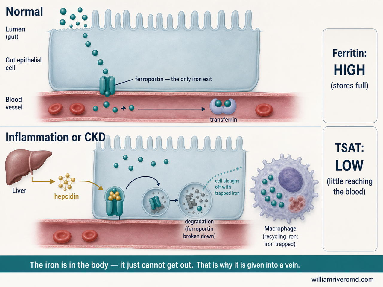Diagram comparing normal iron export through ferroportin with hepcidin-blocked export in inflammation and CKD, showing iron trapped inside gut lining cells and macrophages