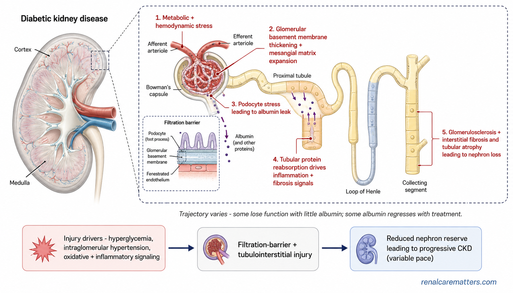 Schematic showing how diabetic kidney disease injures the nephron in five stages — metabolic and hemodynamic stress, basement-membrane thickening, albumin leak, tubular inflammation, and nephron loss — with a note that the trajectory varies.
