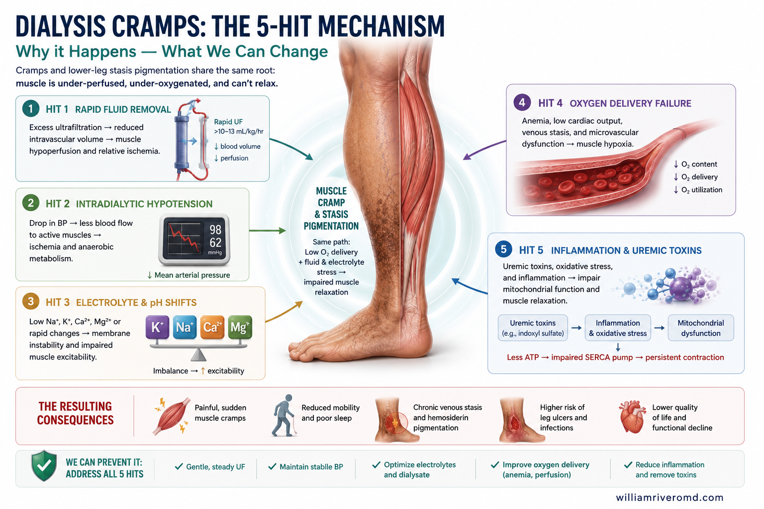 Review-article schematic of the five-hit cramp mechanism converging on SERCA failure — hypoperfusion, contraction alkalosis, electrolyte shift, cofactor-limited ATP, mechanical stretch.