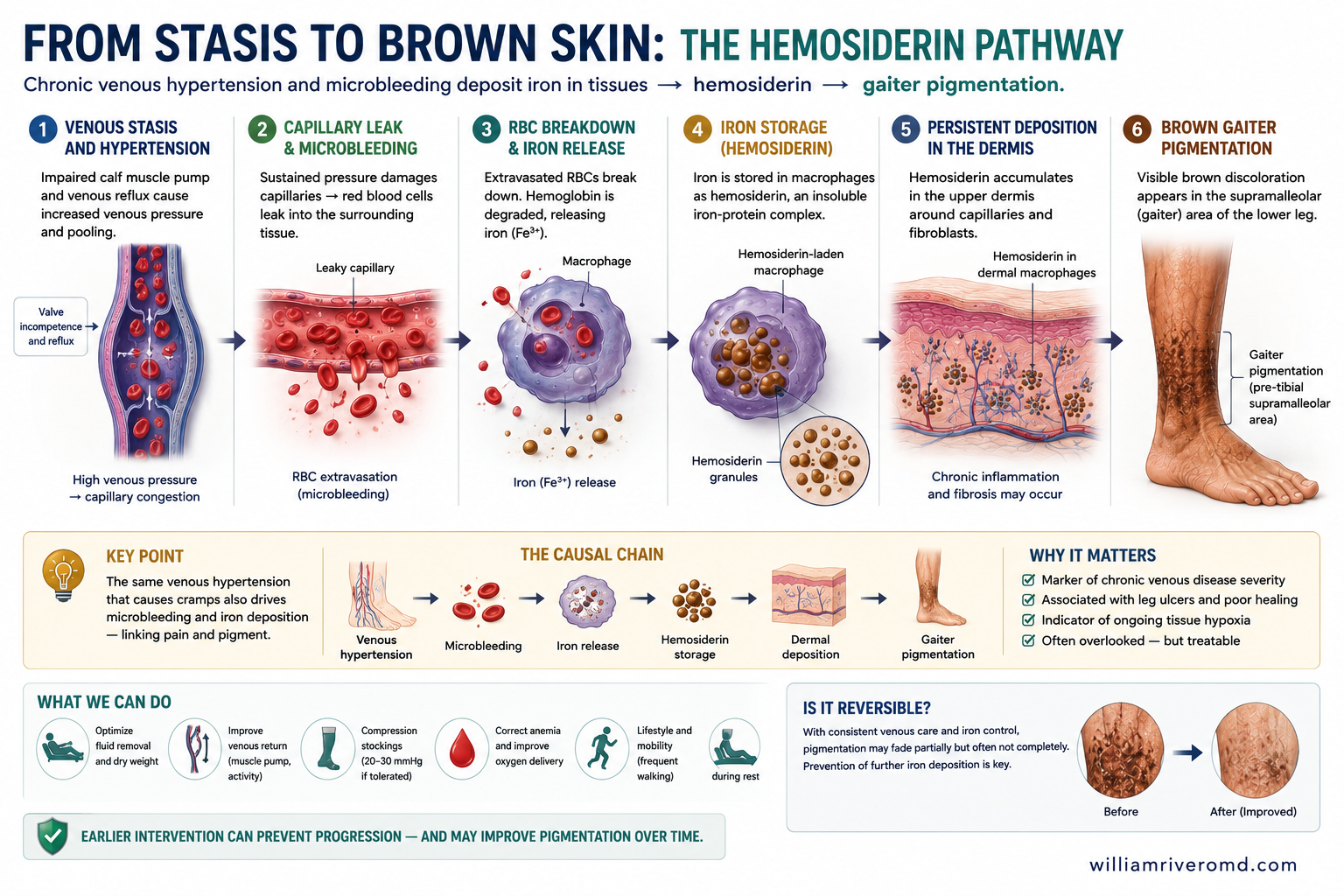 Schematic of chronic venous hypertension widening dermal capillary junctions, with red cell extravasation, hemosiderin deposition, MMP-driven matrix damage, and the consequence ladder to stasis ulcer.