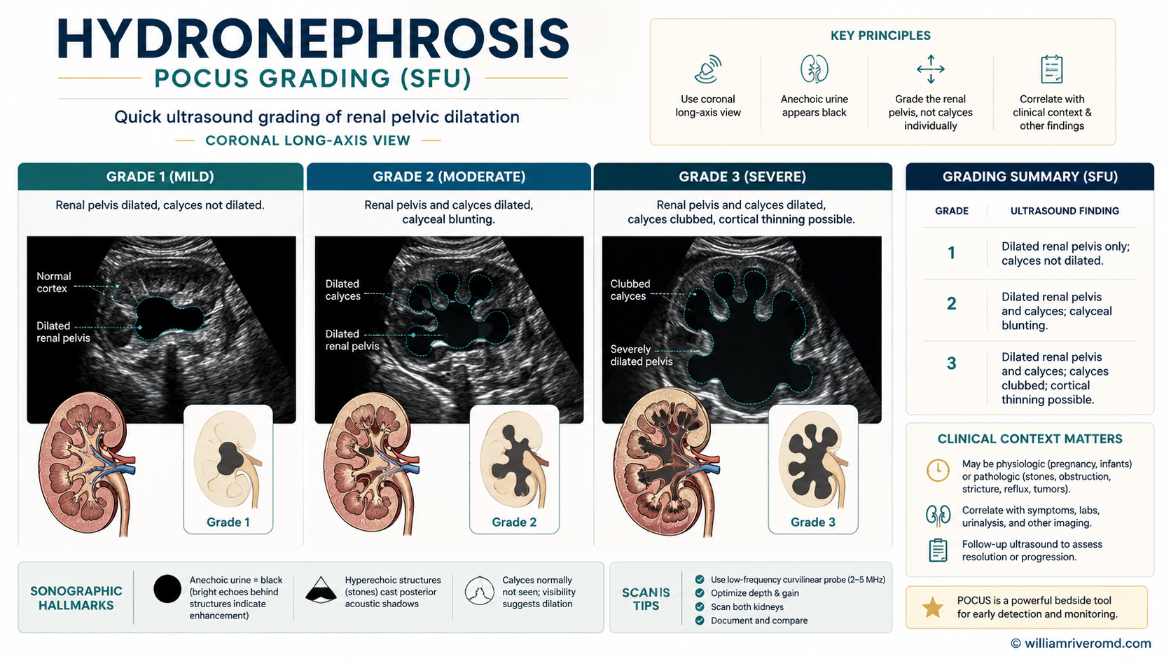 Figure 2 — Hydronephrosis POCUS grading. Three side-by-side grayscale B-mode panels (mild, moderate, severe) with paired coronal-anatomy insets, showing progression from a dilated pelvis with preserved cortex (mild) → rounded bear-paw calyces with early thinning (moderate) → ballooned anechoic calyces with marked cortical thinning (severe). Each panel carries a cortical-thickness caliper.