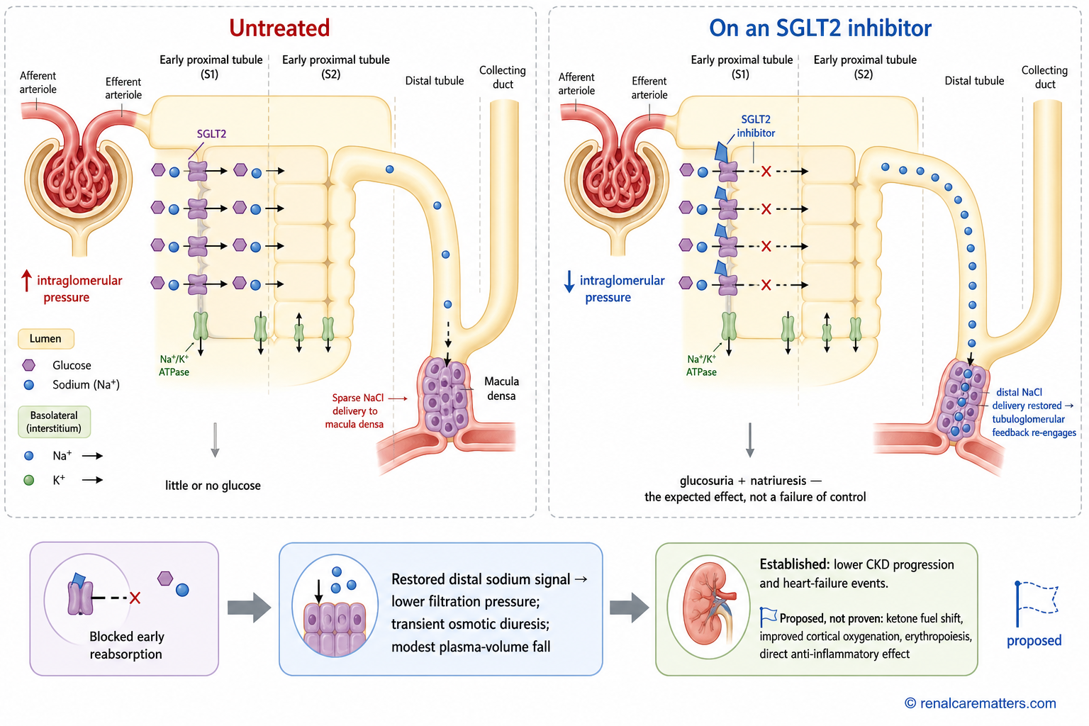 Before-and-after diagram of SGLT2 inhibition showing restored sodium delivery to the macula densa, glucose loss in urine, and reduced glomerular pressure