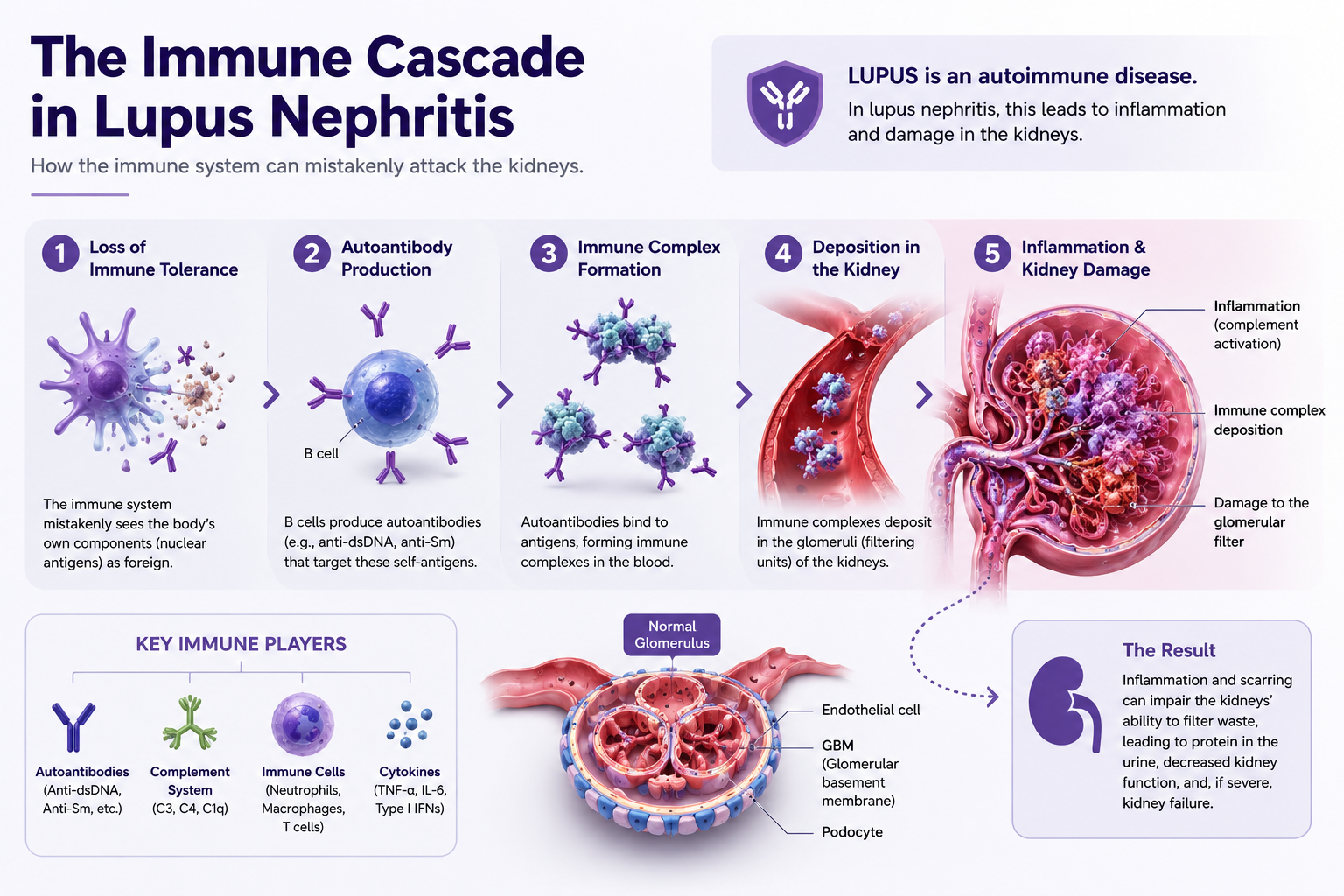SLE immune cascade flow diagram: from triggers through autoantibody production and glomerular deposition to kidney damage outcomes