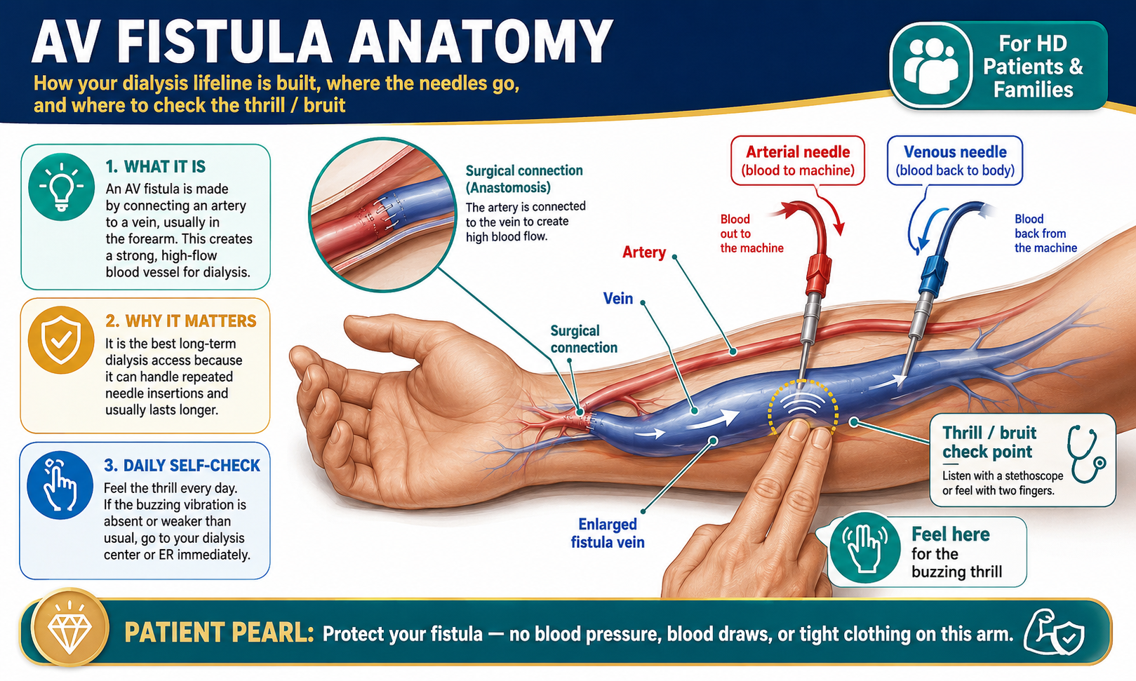 AV fistula anatomy — showing the surgical artery-to-vein connection in the forearm, enlarged vessel, and needle insertion sites