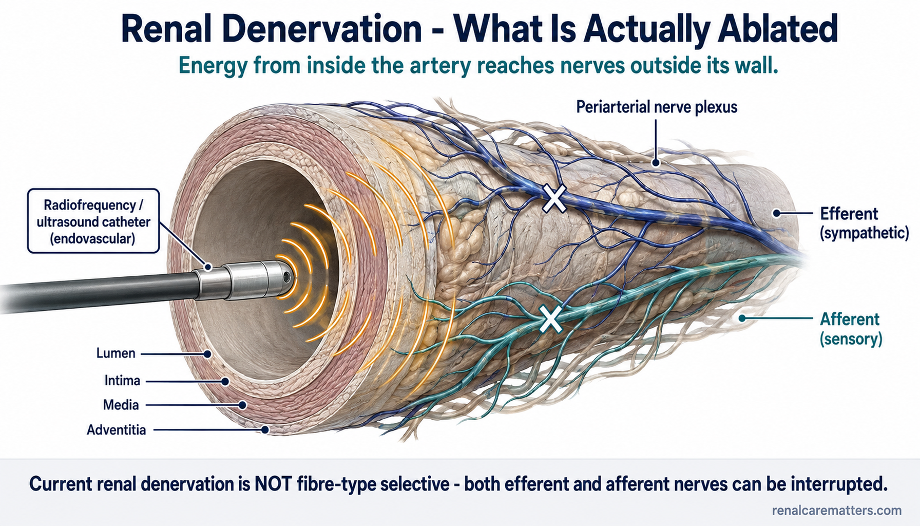 Cross-section of a renal artery. The lumen contains an endovascular catheter emitting energy outward. Nerve fibres sit outside the arterial wall; both an efferent and an afferent fibre are shown being interrupted by the energy.