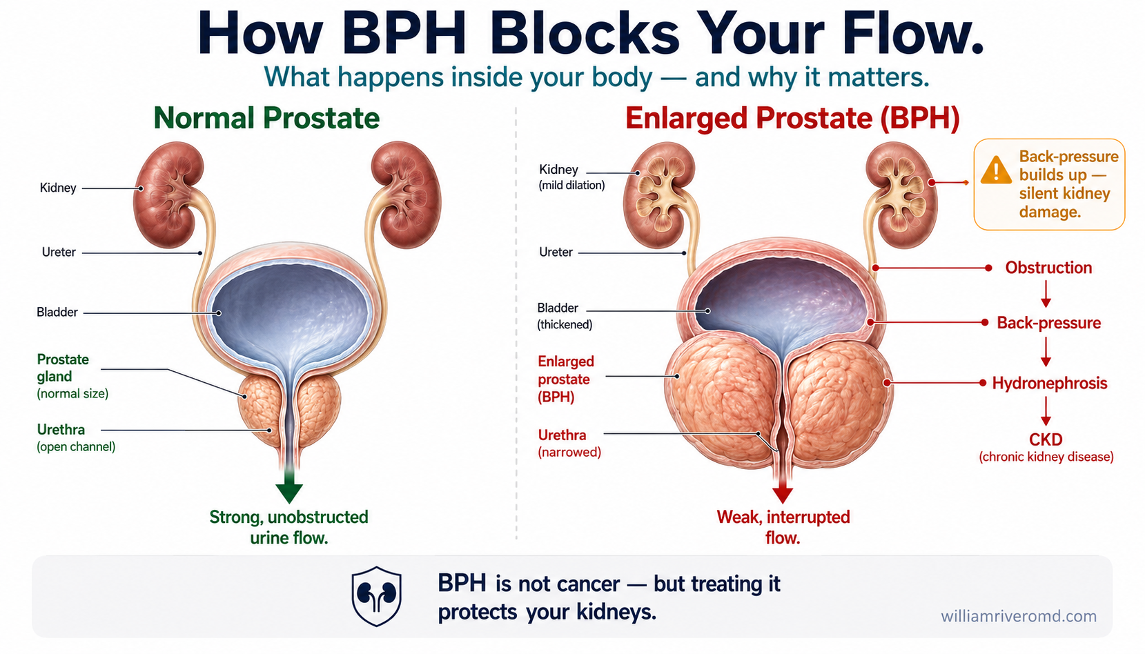 Normal prostate vs BPH — how an enlarged prostate compresses the urethra, causing back-pressure, hydronephrosis, and silent CKD