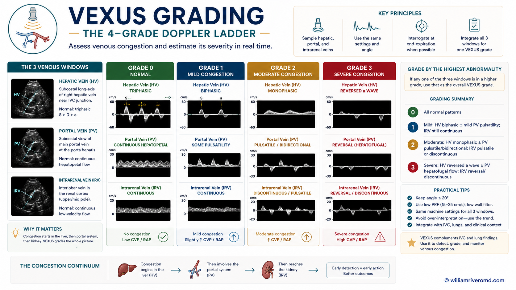 Figure 5 — VEXUS four-grade Doppler ladder. Four rows (Grade 0 → 3, top-to-bottom, color-coded green → amber → orange → red) with three columns of pulsed-wave Doppler waveforms (hepatic, portal, intrarenal) and an IVC reference at left. Progression: Grade 0 IVC < 2 cm, hepatic S > D, portal pulsatility < 30%, renal continuous → Grade 3 IVC ≥ 2 cm with hepatic S-wave reversal, portal ≥ 50% pulsatility, monophasic intrarenal.